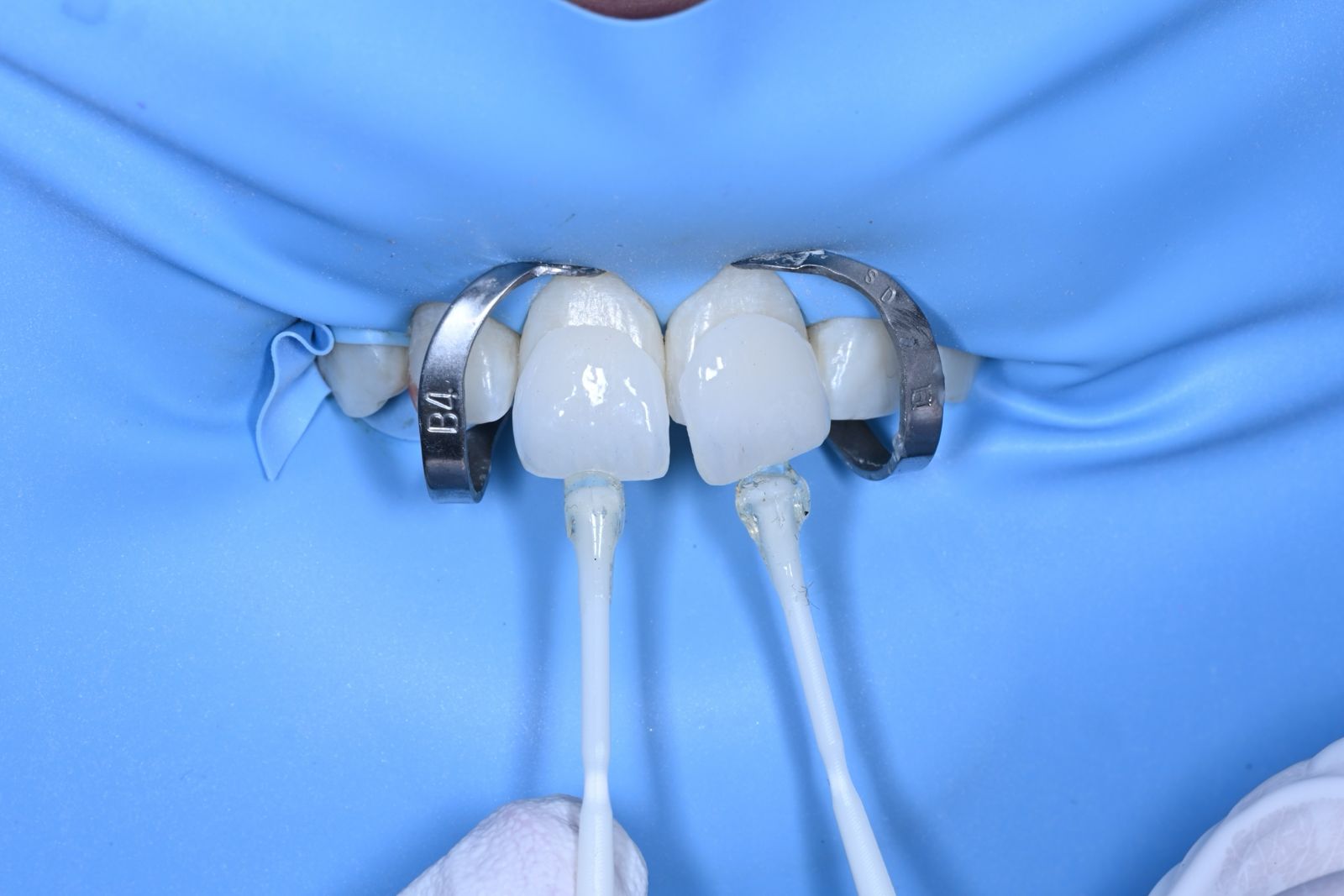 Smile Makeover Workflow